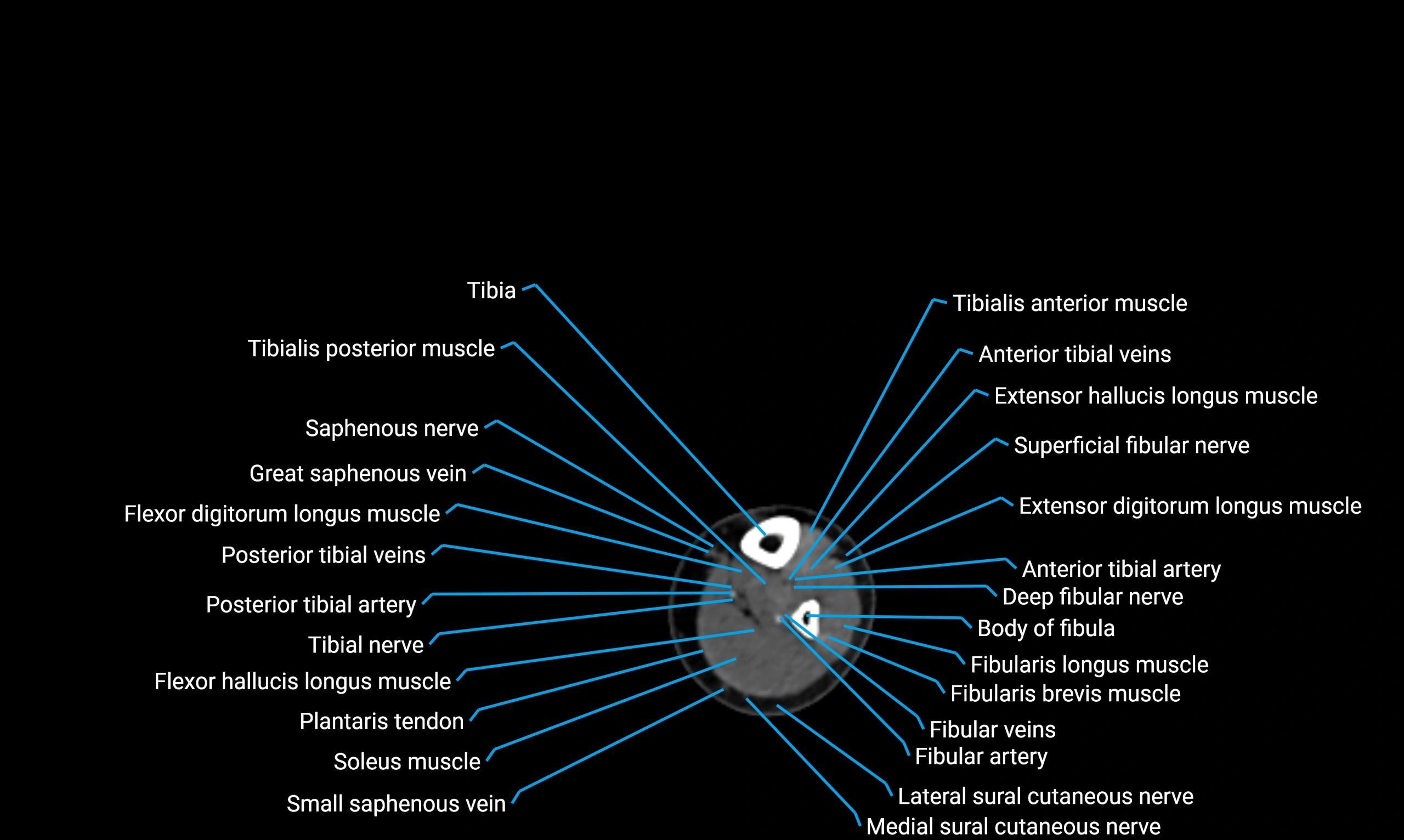 CT lower limb axial cross sectional anatomy labelled image 138 (2).webp